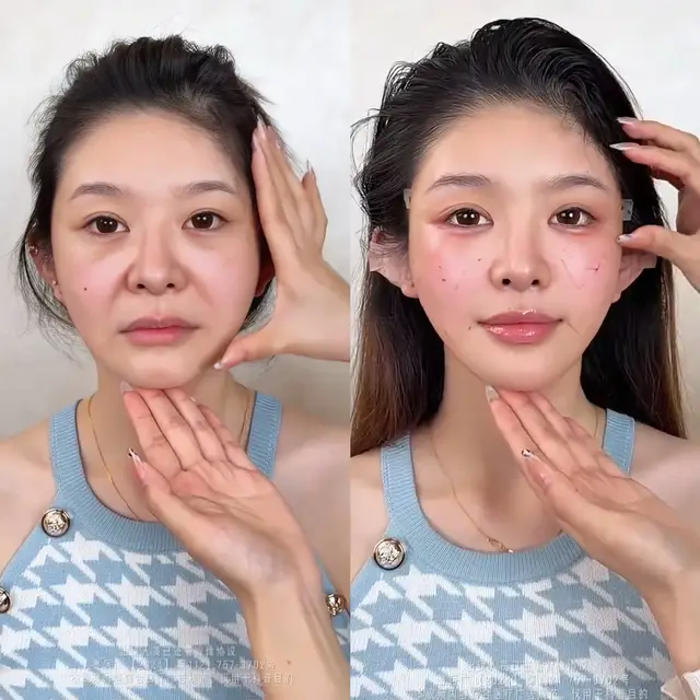 #9D #面部提升 #减龄 #反差 #整形 