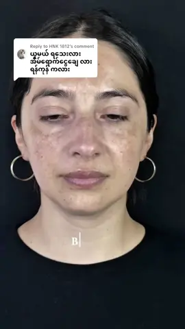 Replying to @HNK 1812#goldenaura #fyp #trending #အမဲစက်၊တင်းတိပ်ရှိသူများအတွက် #အမဲစက်အမာရွတ်ပျောက်ချင်သူများအတွက် 