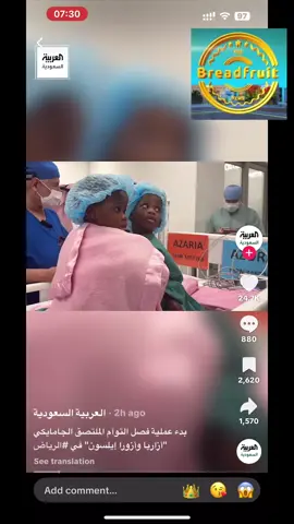 The Jamaican conjoined twins Azora & Azaria Elson have been separated according to Saudi TikTok and Al Ekhbariya news channel.   شكرًا لكل أهل السعودية على التحديثات 🙏🇸🇦 More updates as soon as they drop.