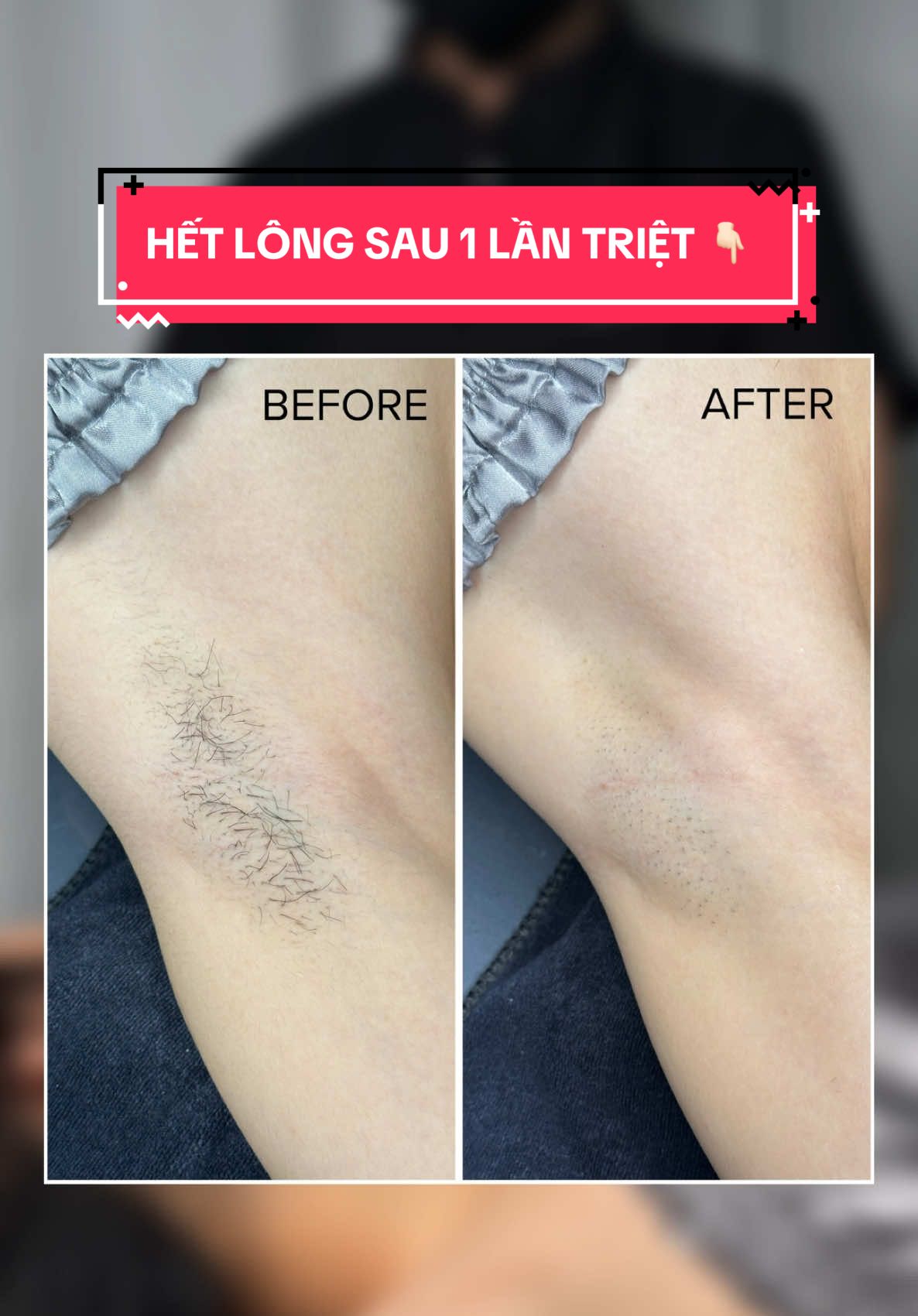 💥 TRIỆT LÔNG NÁCH CHỈ 149K 💥 Chỉ với 149K, bạn đã có thể trải nghiệm dịch vụ triệt lông nách lạnh công nghệ cao tại TSS GLOW-LAB – nhanh, mát lạnh, không đau rát, trả lại cho bạn vùng da sáng – khô thoáng – mịn mượt ngay sau buổi đầu. 💬 Lịch triệt đang kín nhanh mỗi ngày – inbox giữ suất triệt chỉ 149K ngay hôm nay để kịp “cánh thơm, da mịn” trước cuối tuần nhé! #trietlong #tssglowlab #viralvideo 