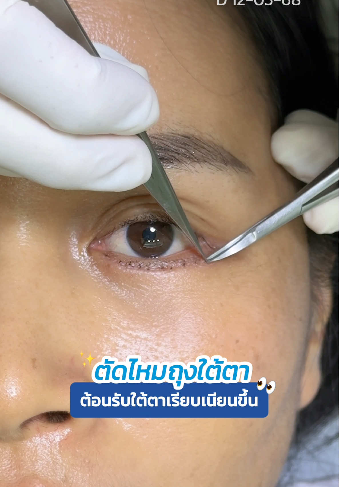 ตัดไหม #กำจัดถุงใต้ตา 👀 ต้อนรับใต้ตาสดใส 🤩 #ตัดถุงใต้ตา #ทีมแพทย์หมอสกาย #skyclinic #จักษุแพทย์ 