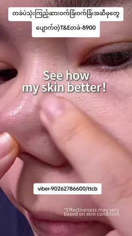 #tesoap #tiktok #foryou #ဆားဝက်ခြံပျောက်ချင်သူများအတွက် #လှိုင်သာယာကိုယ်စားလှယ် 