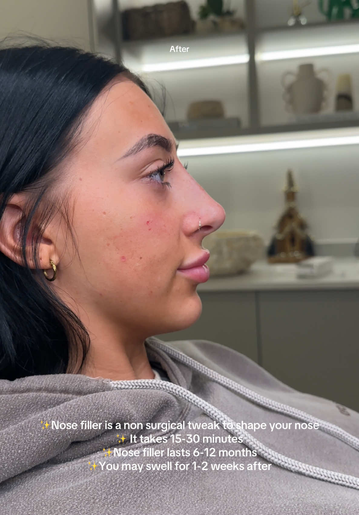 No doubt all of our clients are already gorgeous. But a little bit of nose filler can help smooth a small bump on a nose for a subtle, natural result ✨ Quick, non-surgical and under 30 minutes! #nonsurgicalrhinoplasty #nosefiller #filler #facialaesthetics #leeds #SelfCare 