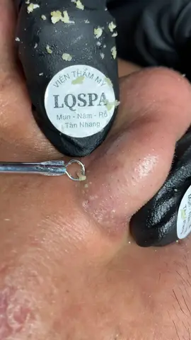 Mềm nha #chamsocdamun#chamsocdaseo#chamsocdanam#tanbinh#Lqspa&academy