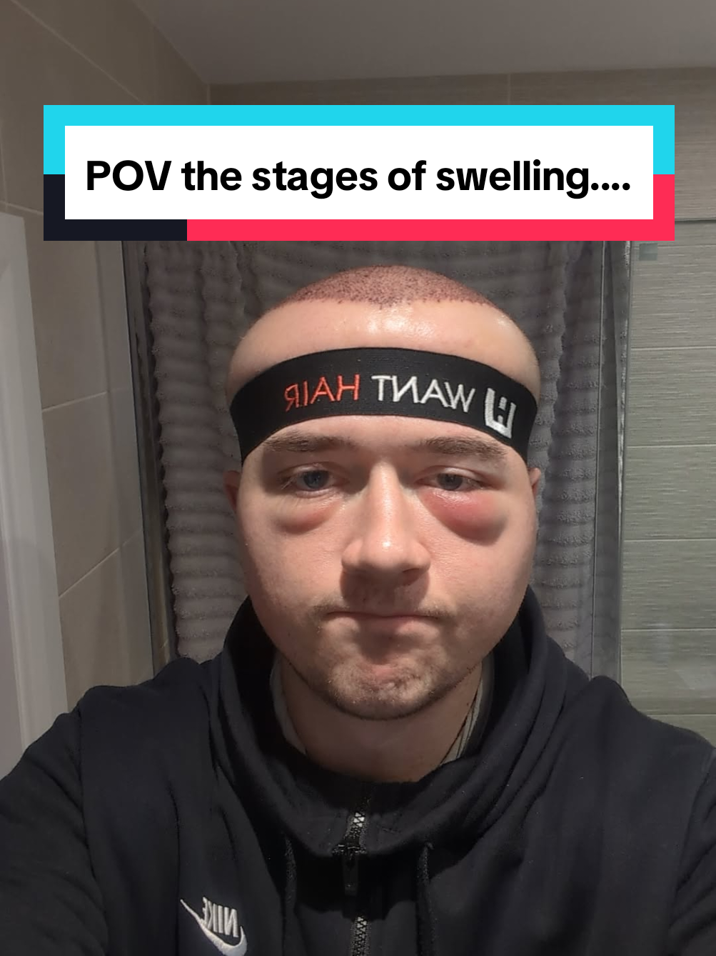 My journey to a fat head... it's been a wild ride 🙃 #swelling #hairtransplant #hairlosstreatment 