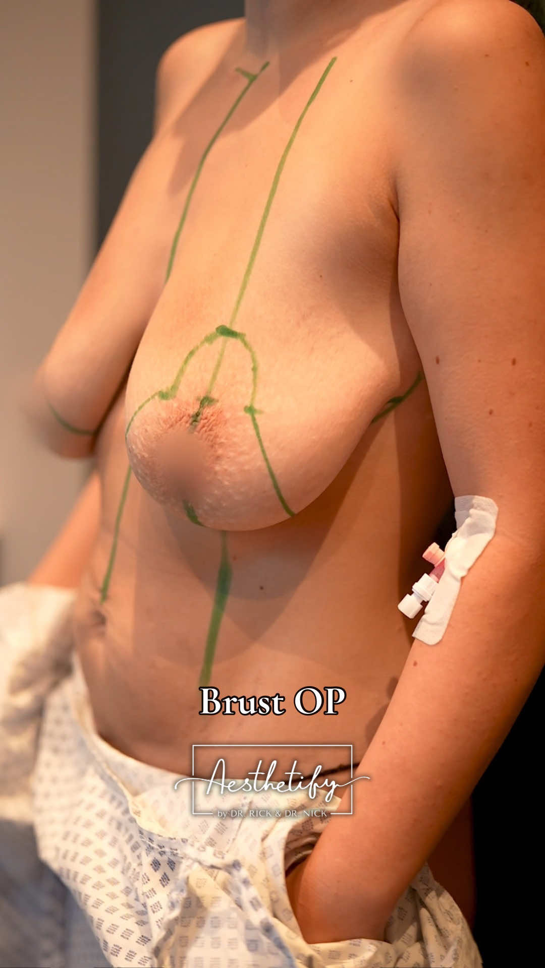 Neue Brust, neues Gefühl ✨ [Educational Purposes] Kennt ihr das, wenn die Brust nach Schwangerschaft oder Gewichtsverlust einfach an Form verliert? Eine Brust-OP kann Volumen zurückbringen, Straffheit geben oder Asymmetrien ausgleichen.🍒🌸 @Dr. med. Alexis Kauth  #transformation #düsseldorf #beauty #beautydoc #GlowUp  