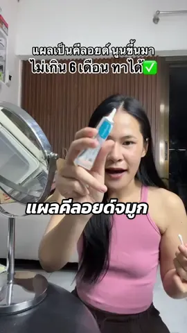 ใครเสริมจมูกมาแล้วพบเจอปัญหาแบบเราทุกคนมาใช้กันได้เลย #แผลเป็นคีลอยด์หลังเสริมจมูก #แผลเป็นนูน #แผลเป็นคีลอยด์ 