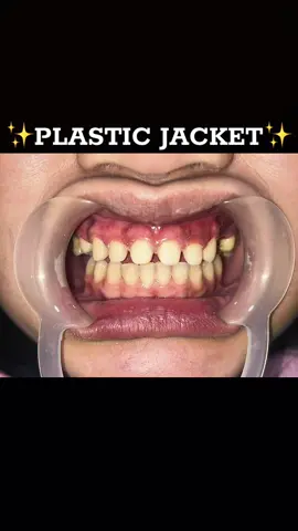 🦷PLASTIC JACKET🦷                                                            ✨ Find Comfort in Your Smile ✨ In a quiet corner made for care, we welcome you with warmth in the air. Sit, breathe, let worries fade— your smile is safe in the hands of gentle aid. 🦷🌿               #plasticjacket #porcelain #tilite #emax #zirconia 