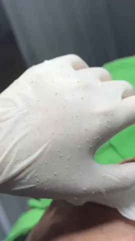 Lấy mụn chỉ 99 cá ❌😱 #duocmypham #duocsilinh #peelda #trimuntritham #xuhuongtiktok 