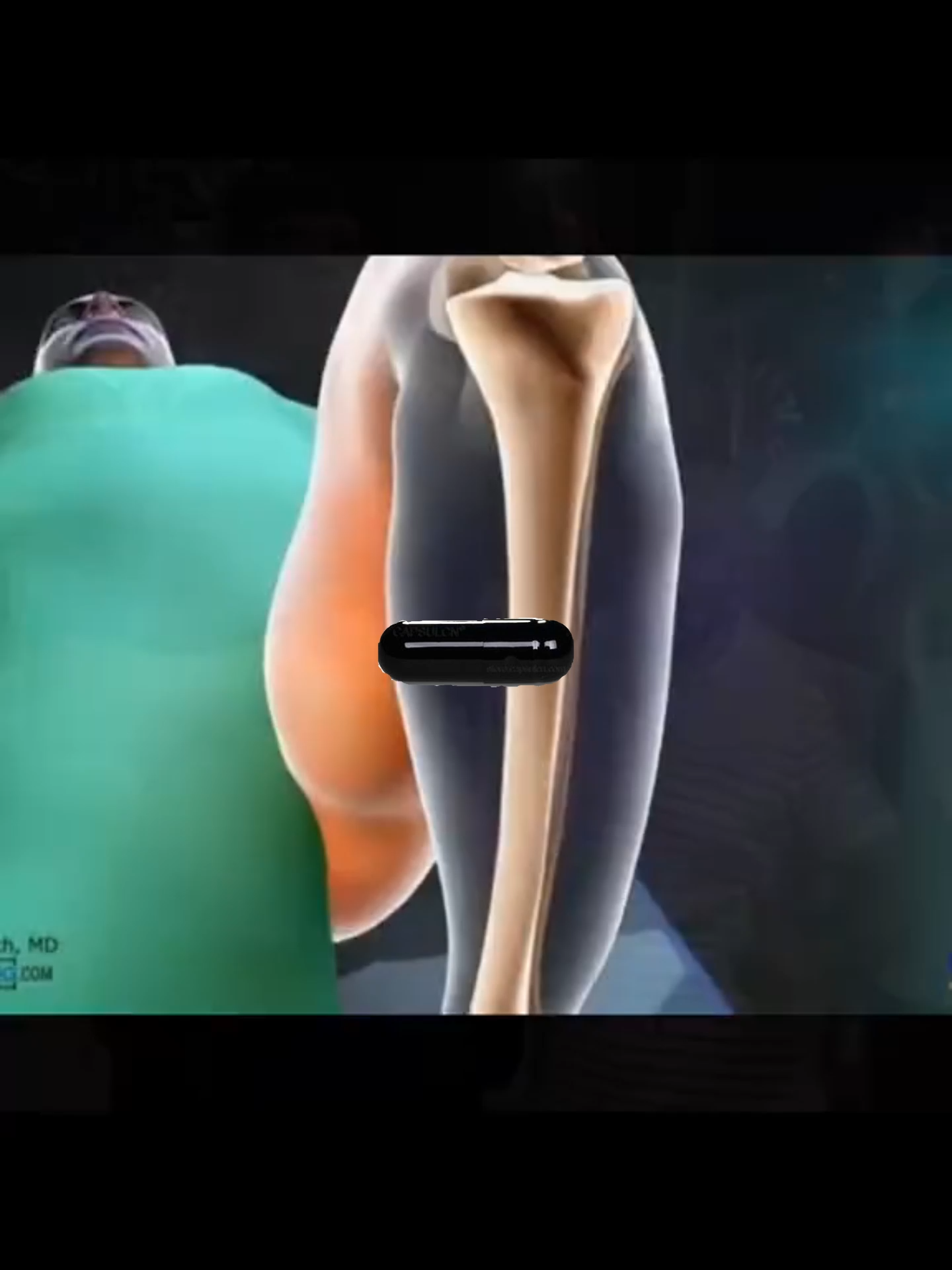 the first video about bp😥#bp #blackpill ##fyp #fypツ #height #hgh #igf1