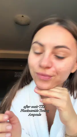 Pori dilatati? Piele deshidratata, uscata, acnee si puncte negre?  Solutia este @coxir TXA Niacinamide Toning Ampoule.  Dupa 7 zile, se vad imbunatatiri. Ten mai luminos, hidratat, pori micsorati, disparitia punctelor negre.  Il folosesc zilnic, de 2 ori pe zi, intr-o rutina complexa.  Tu te confrunti cu astfel de probleme? Ce produse- minune ai in rutina ta zilnica?    #coxir #koreanskincare #kbeauty #toning #glowyskin #amazonfinds @coxir @theskinhouse_official 