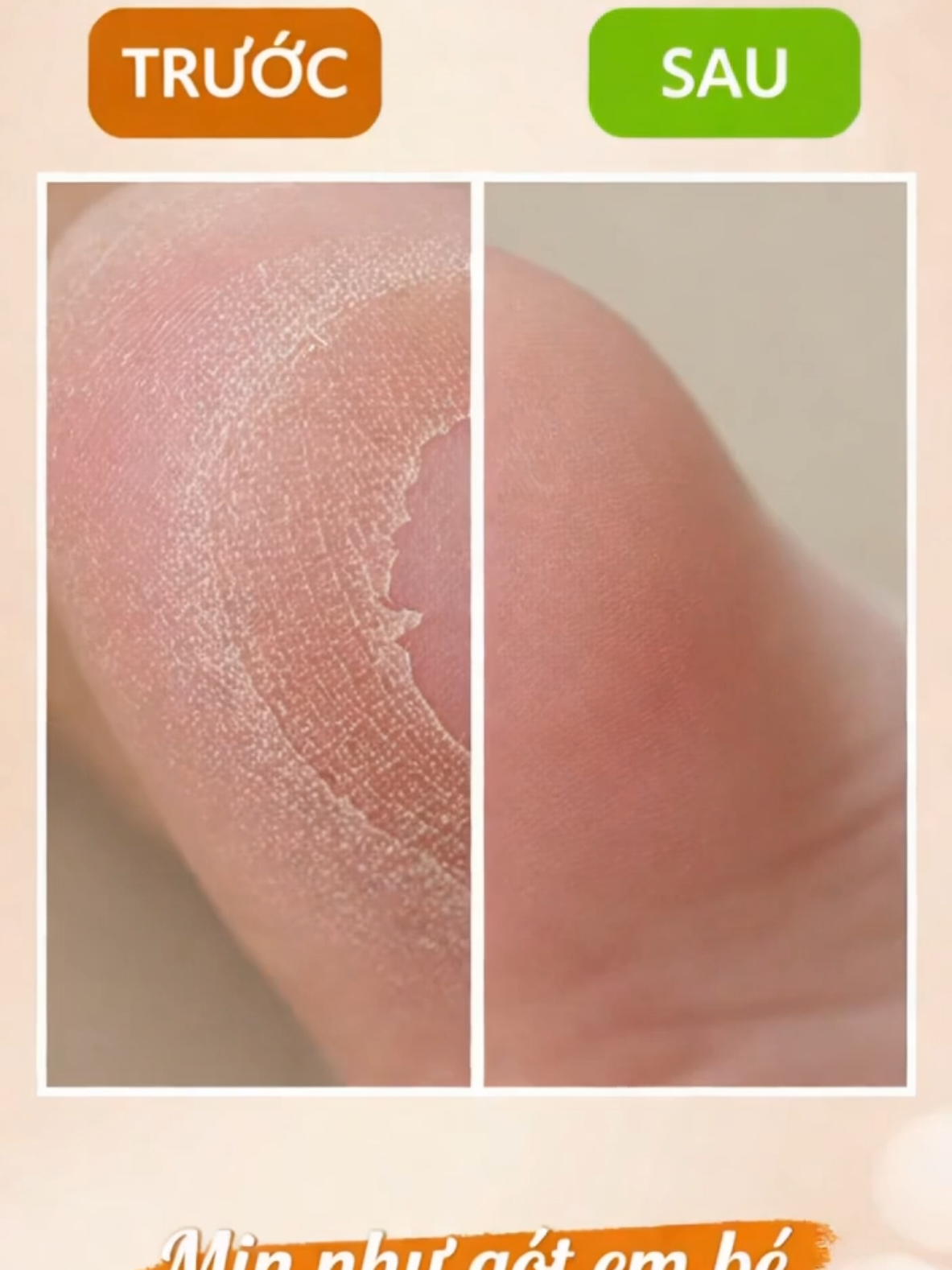 mặt nạ ủ chân loại bỏ da chết tăng độ ẩm dưỡng chất cho da mềm mại#duongda #trịmun #matnahutmun #uchan #matnauchan @Cần phiêu lãng 