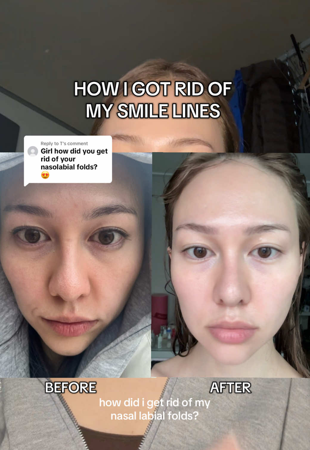 Replying to @T How I “got rid” of my nasal labial folds (A.K.A the smile lines)  Use my yesstyle code ABBIEPICK5 to save $$  Products mentioned: @SUNGBOON EDITOR Power Boosting Cream In Serum (contains volufiline)  @넘버즈인 numbuzin No. 9 NAD RetinA Volume Shot Eye Cream #smilelines #eyebags #retinoleyecream #koreanskincare 