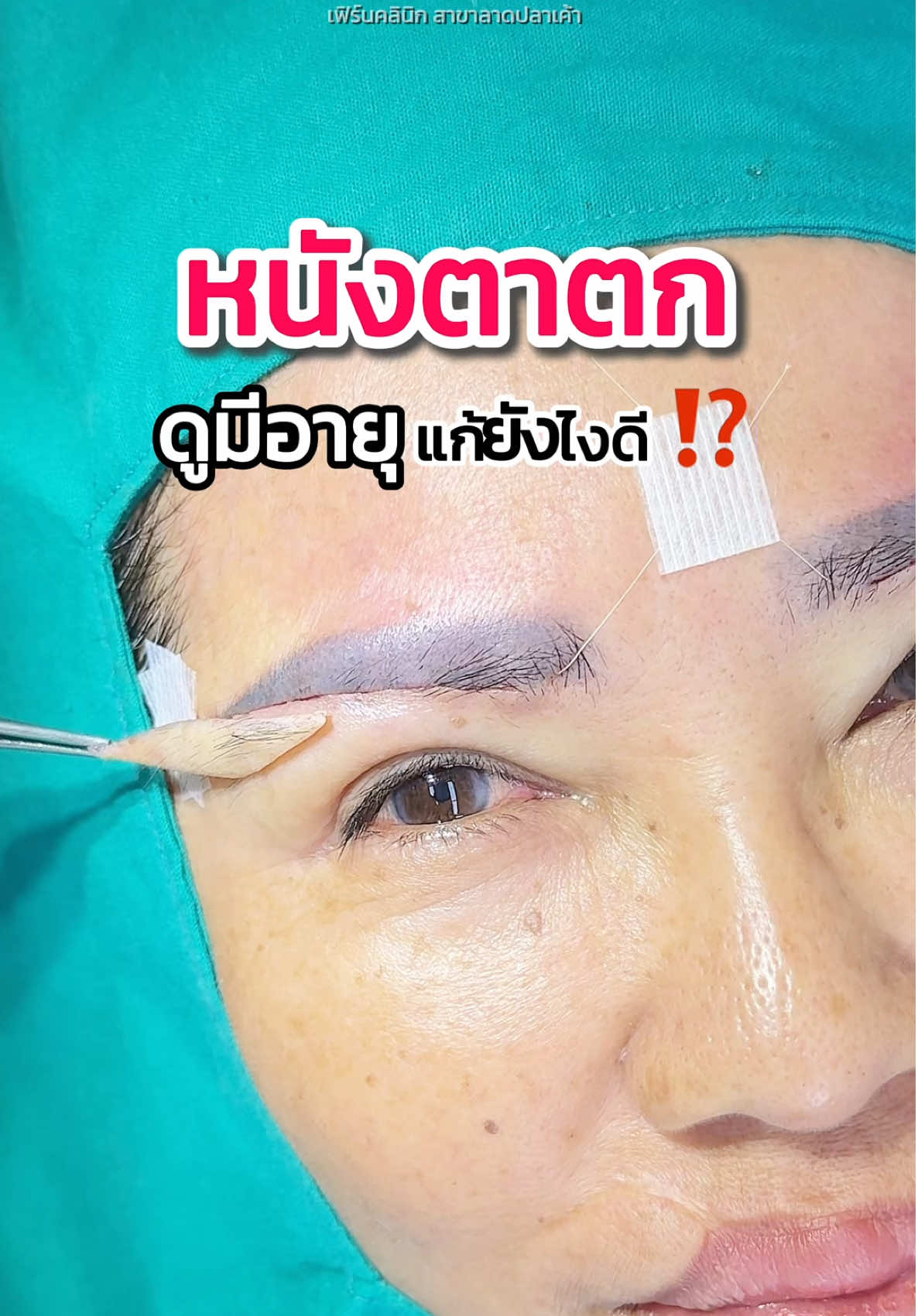 หนังตาตก ดูมีอายุ แก้ยังไงดี ⁉️ #ทีมแพทย์fernclinic #subbrowlift #ตาสวย #ศัลยกรรม #tiktokviral 