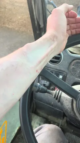 Bonjour bonjour, j’ai besoin de savoir si il y en a parmi vous qui ont subi un prélèvement d’artère. Dans mon cas c’est l’artère radiale qui a été autogreffé à mon pied pour le sauver lors de mon accident. Depuis j’ai par moment des engourdissement qui partent du bout des doigts vers le coude c’est assez désagréable et souvent couplée d’une douleur comme celle d’une croissance d’os…est-ce que cela vous arrive aussi ❓🙋‍♂️#chirurgieplastique #greffe #sante #pourtoi #cicatrice 