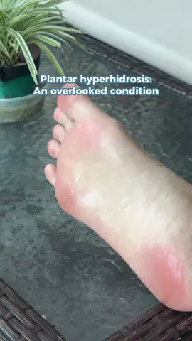 No one talks about sweaty feet — but we’re done hiding it 🦶💦 #plantarhyperhidrosis #sweatyfeet #Dermadry #hyperhidrosis