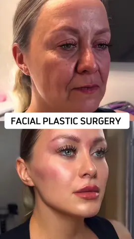 My Chinese three-point facial lift is a plastic surgery technique that completely improves facial sagging and wrinkles through surgical or non-surgical methods. The principle mainly includes the following aspects: 1. Enhancement of SMAS layer: The SMAS layer is a layer of connective tissue between the facial skin and muscles. By enhancing the SMAS layer, facial skin can be tightened, reducing wrinkles and sagging. 2. Ligament elevation: There are many ligaments on the face that connect the facial bones and muscles. By lifting these ligaments, the facial support structure can be enhanced and sagging can be reduced. 3. Fat reset: The distribution and location of facial fat can also affect the appearance of the face. By adjusting the position and distribution of fat, facial contours and lines can be improved The surgical process takes only 20 minutes to recover, and the recovery period can last for 2-3 days Sustainable results 8-12 years #整形 #抗衰老 #医美 #变美 #面部提升 
