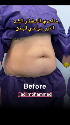 شفط الدهون و شد الجسم بالفيزر #lipo360 #شفط_الدهون_بالفيزر #نحت_الخصر #tummytuck #abdominoplastia 
