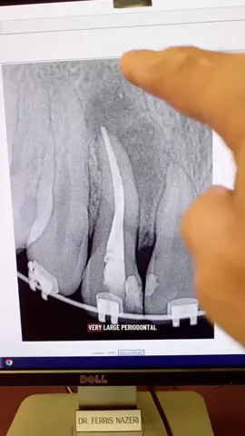 Show THIS to a holistic or biological “dentist!” #dentists #dentalstudent #rootcanal #dentalhygienist #dentalofficelife 