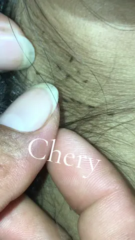 Remove lice #😱😱😱omg #🥶🥶🥶 #😭😭😭 #😂😂😂 #lice 