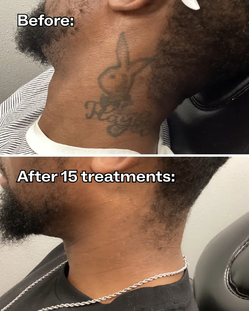 Tattoo? History. Confidence? Elevated. Complete removal after 15 treatments at Removery🏆