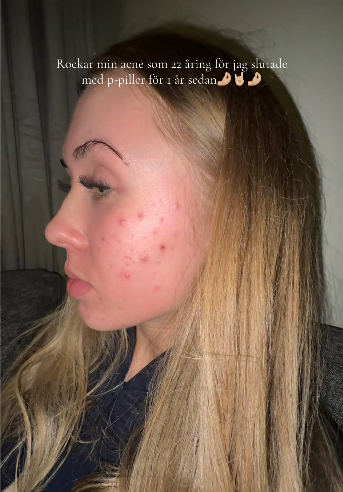 Har för övrigt aldrig tidigare haft problem med acne👌🏼#ppiller 😁