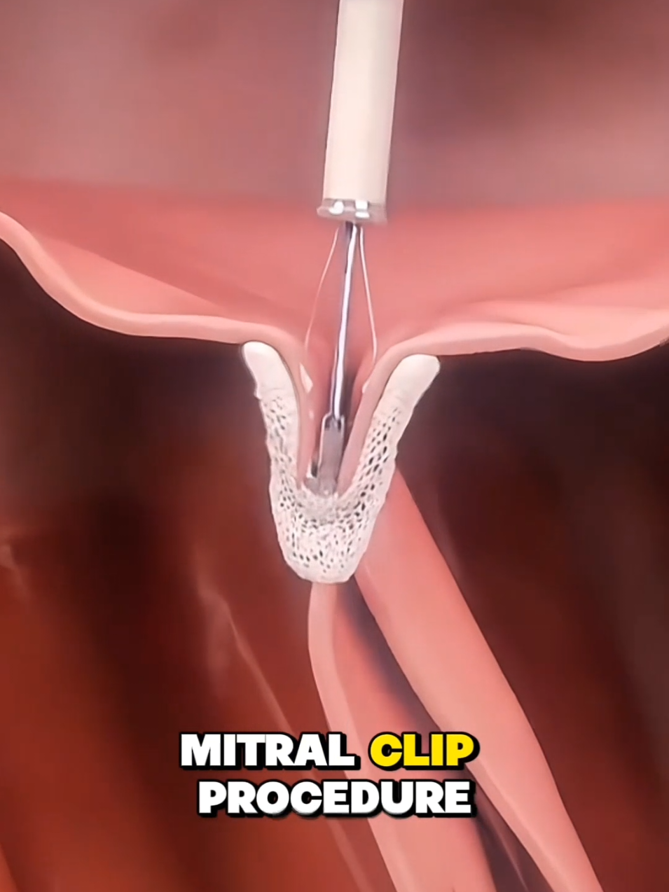 Ever wondered how a leaky wall is fixed? #MitralValveFixation #MitralValveRepair #MitralRegurgitation #HeartValveSurgery #CardiacProcedure