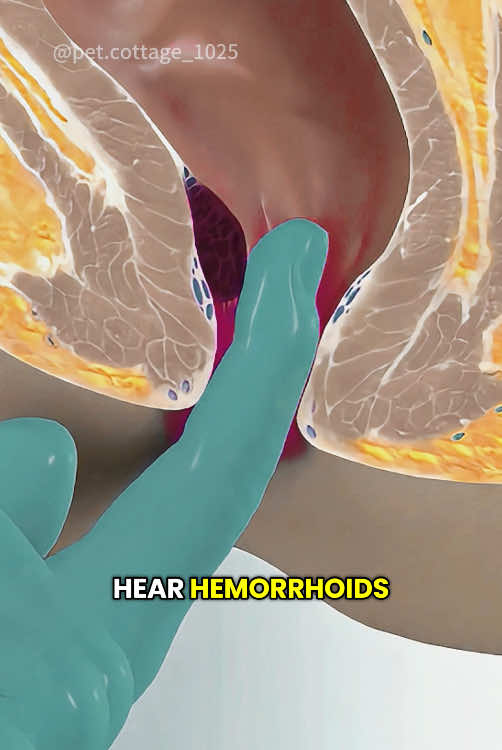 3d animation of Piles rubber band surgery#animation #piles #rubber #band #hemmorhoids #hemorroides #pilesrubberband #surgery #animation #3danimation #hemmorhoidsawareness
