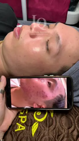 Cập nhập da khách #chamsocdamun#chamsocdaseo#chamsocdanam#tanbinh#Lqspa&academy