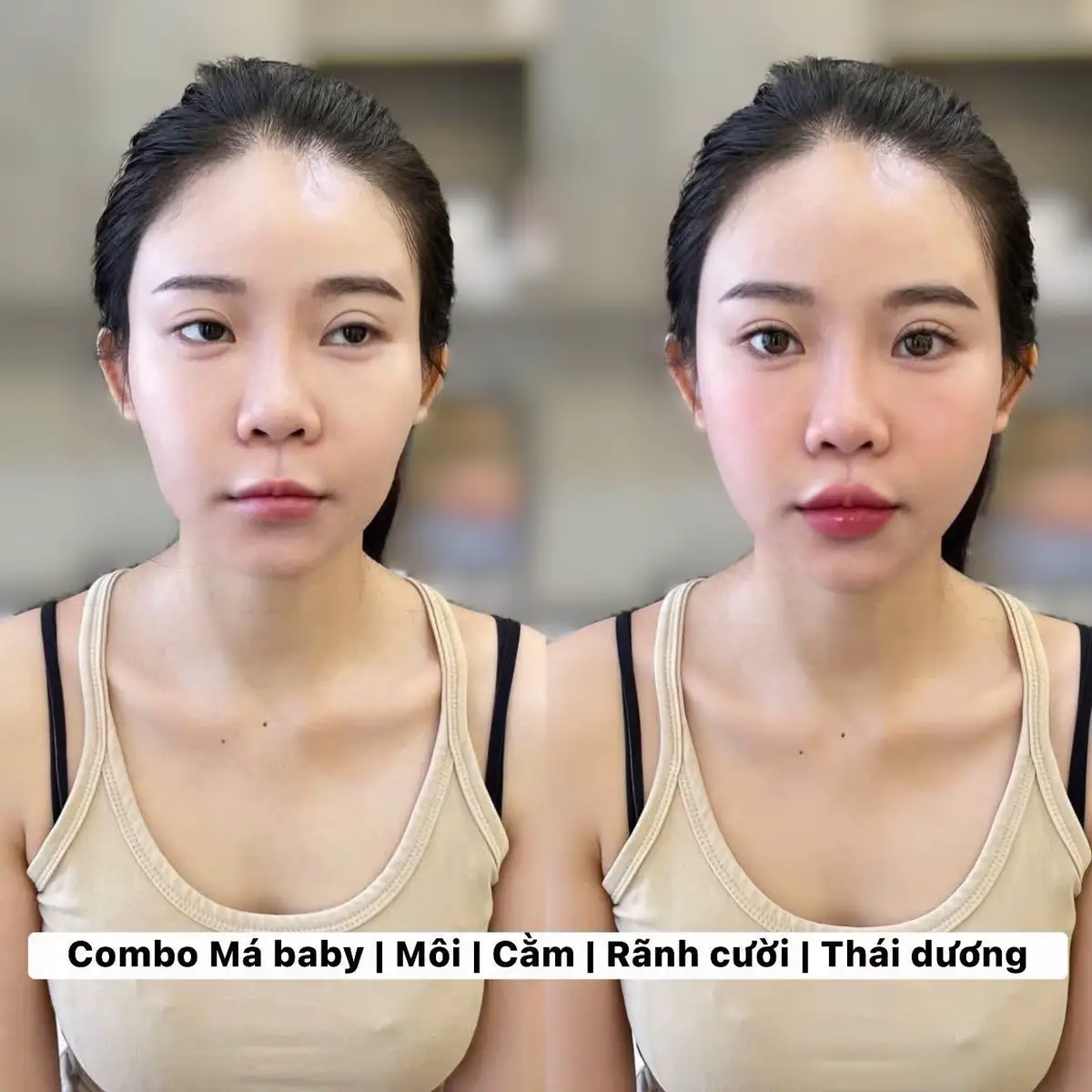Hẵn là xinh như búp bê #filler #botox #xh #làmđẹp 