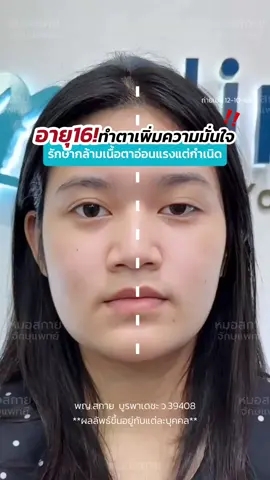อายุ 16‼️ ทำตาเพิ่มความมั่นใจ รักษา #กล้ามเนื้อตาอ่อนเเรง แต่กำเนิด🥺 #รีวิวตาสองชั้น #ตาปรือ #หมอสกาย #สกายคลินิก