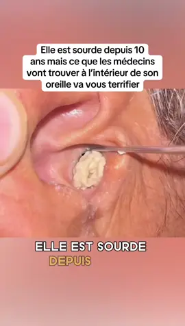 #cejour-là #ApprendreSurTikTok #histoirevrai #oreille #sourd 