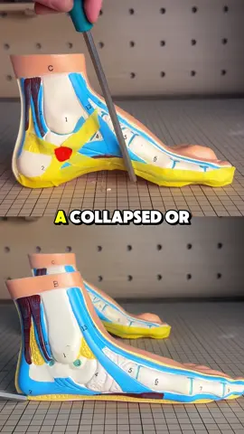 Foot pain is your arch collapsing in real time#OwnYourJourney #WalkTheExtraMile #insoles #tiktokshop #tiktokshopblackfriday 