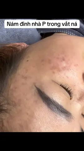 Nám đinh công nghệ enzym đtri vừa nhàn ,da khoẻ mà trong,cod thấp.Ce cần phác đồ ib P chia sẻ nha#nám #mụn #maketing #kinhdoanhspa 