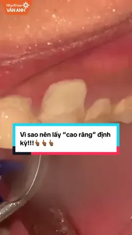 Vì sao nên lấy “cao răng” định kỳ!!!#nhakhoavananh #nhakhoauytin #laycaorang #xuhuong #hanoi 