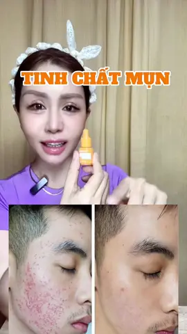 Tinh chất mụn từ nọc ong của nhà Almonds xuất sứ Việt Nam ,lọ 5ml dành cho da dể nỗi mụn.hổ trợ mụn ẩn, mụn bọc, mụn viêm trả lại làn da sạch khỏe …#mụn #serumtrimun #trimun #skincare #phunu 