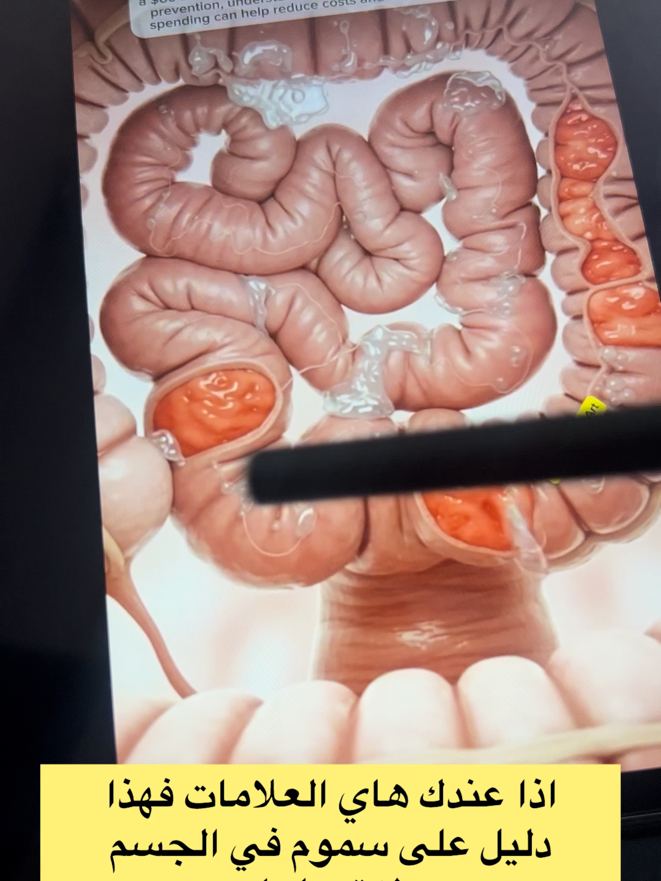 #الشعب_الصيني_ماله_حل😂😂 #السعودية #القولون_العصبي