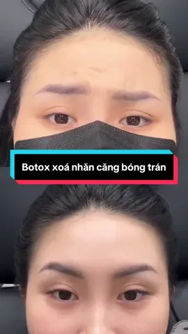 Bí quyết giúp chị em có trán căng bóng, soi gương được luôn đó là tiêm botox xoá nhăn trán giúp căng loại bỏ nếp nhăn sau 7-10 ngày thực hiện#xuhuongthammy #xuhuong 