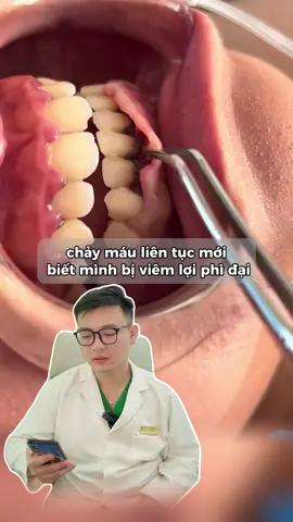 Cẩn thận viêm lợi phì đại, hãy đi khám sớm để phòng tránh nha #nhakhoa #rangmieng #viemloi #hoimieng #fyb 