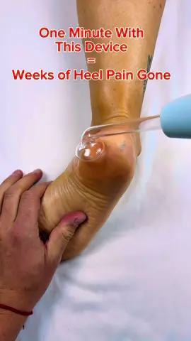 🔥 “If Your Heel Pain Isn’t Going Away… THIS Is Why.” 🔥 Most people stretch, ice, or buy new shoes—but nobody talks about what’s actually happening inside your foot. Plantar fasciitis isn’t just “tight tissue.” It’s inflamed fascia fibers + stuck nerve signals + poor circulation all trapped in one of the most overloaded areas of your body. ⚡️ This is where the High-Frequency Wand comes in. The vibration + microcurrent frequency sends deep waves through the plantar fascia that your hands physically can’t reach. What it really does: ✅ Breaks up adhesions hiding under the heel ✅ Improves micro-circulation instantly ✅ Stimulates nerve pathways for faster healing ✅ Reduces inflammation without aggressive pressure ✅ Relaxes the entire kinetic chain (ankle → calf → hamstring) People feel that zing because the fascia FINALLY starts releasing. 💥 60 seconds with the frequency wand = the relief people chase for months. If your heel is throbbing when you wake up or burning after standing… THIS is the tool your plantar fascia has been begging for. 👇 Save this. Your feet will thank you.