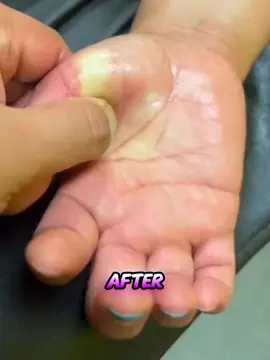 Find Fast Relief From Tingling, Burning Hands & Feet — Click Link In Bio Now 👇 #fyp #ForYou #ForYouPage #Viral #PainRelief #ChronicPain #Neuropathy #NervePain #BurningFeet #TinglingHands #PeripheralNeuropathy #DiabeticNeuropathy #NaturalRemedies #HealthTips #ClickLinkInBio