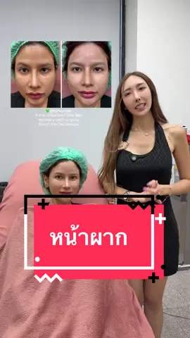 หน้าผาก 4 cc #หมอป๊อปยกหน้า #ไหมน้ำหมอป๊อป #แก๊งฮาเฮ #ร้อยไหมหมอป๊อป 