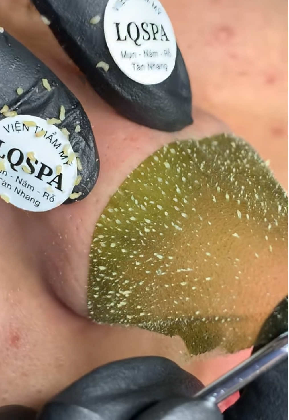 Siêu phẩm #chamsocdamun#chamsocdaseo#chamsocdanam#tanbinh#Lqspa&academy