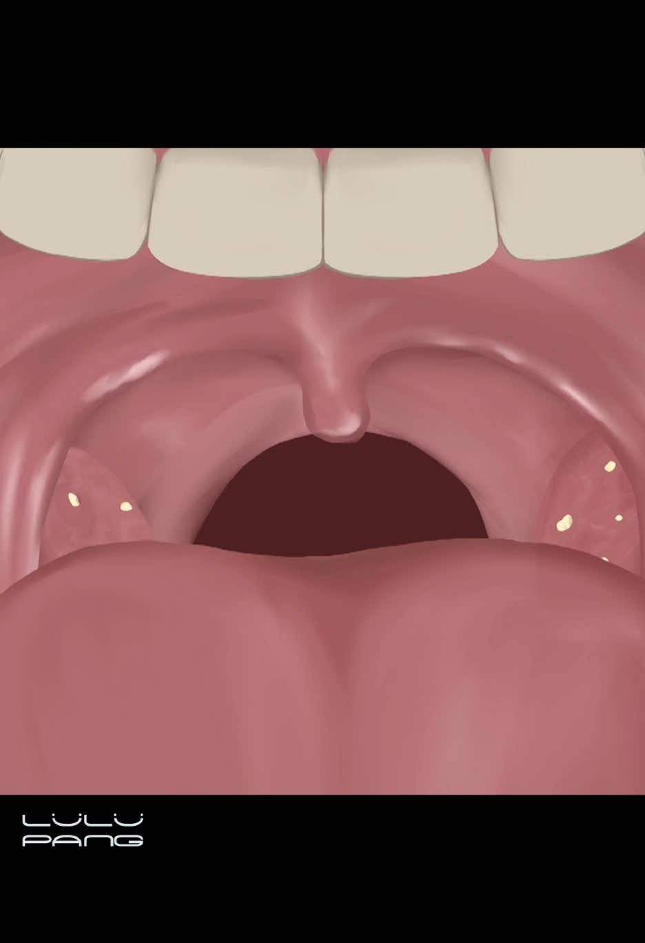 The Real Cause of Bad Breath… Hiding Here 🤢  입 냄새의 진짜 범인😱 #편도결석  #입냄새 #입냄새원인 #편도결석제거 #구취제거 #tonsilstones #tonsilstoneremoval #lulupang 