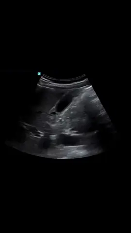 (GB) Gallbladder Adenomyomatosis - Tăng sản cơ tuyến túi mật(mình thấy 1 số BS gọi là U cơ tuyến túi mật) là bệnh lí lành tính thường phát hiện tình cờ trên siêu âm đặc trưng là dày thành túi mật khu trú hay lan tỏa, bên trong có các xoang dịch nhỏ (Rokitansky- Aschoff) và có cấu trúc hồi âm dày dạng đuôi sao chổi. Trong video là 2 ca, thường vùng đáy dễ sót hơn nếu quét nhanh hoặc hơi đường tiêu hóa che khó quan sát. #gallbladder #adenomyomatosis  #sieuambung 