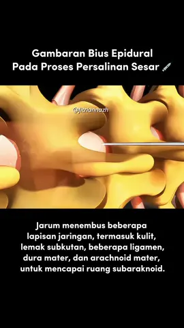 Mana nih yang kemarin bilang, tinggal disuntik urusan beres ⁉️😭😭 Yang sudah pernah ngalamin ini, wajib tag suami masing2 sih 🥹 #anestesi #suntik #bius #melahirkancesar #epidural 