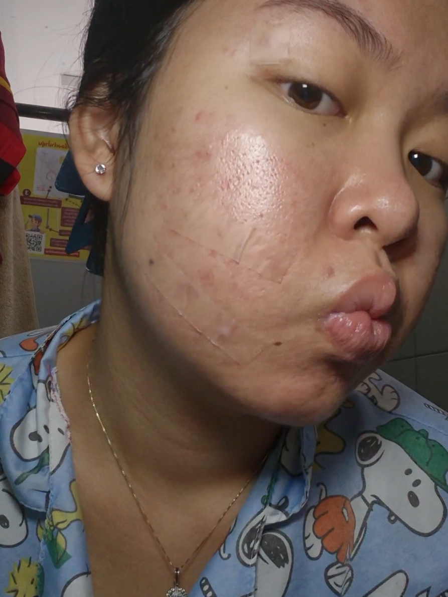 แปะปุ๊ปสิวหลุดปั๊บ‼️#แผ่นแปะสิว #สิว #แผ่นแปะสิวcareq #careq #แผ่นแปะสิวxl 