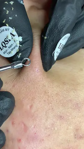 Thiêc #chamsocdamun#chamsocdaseo#chamsocdanam#tanbinh#Lqspa&academy