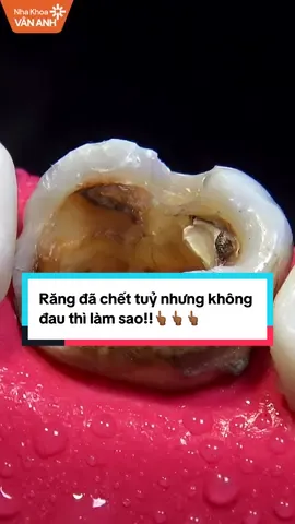 Răng đã chết tuỷ nhưng không đau thì làm sao!! #nhakhoavananh #nhakhoauytin #dieutrituy #xuhuong #hanoi 