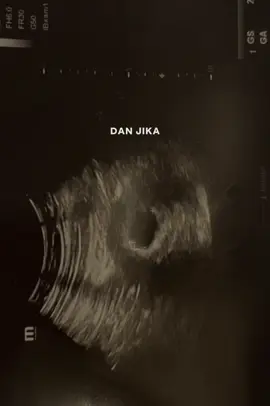 Maih belum bisa move on. Sebahagia itu kemarin mendengar Ayra bakalan punya dede. Tapi tiba tiba chat masuk “kakak kmrn flek gak wktu hamil ayra?” Langsung gak enak hati. Krna fleknya dlu sblm hamil as pembuahan. Yaudah kita cek ke dokter ya besok, sampai di dokter langsung dapat vonis hamil BO. Masyaallah belum rezeki ya dek, kita ikhlaskan dulu untuk kali ini. #CapCut #takdirallah #hamil #blightedovum #fyp 